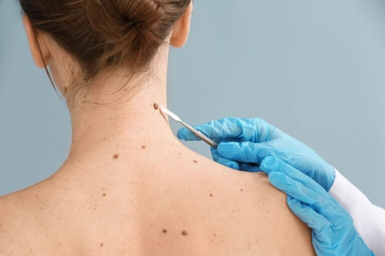 How a Dermatologist Helps Diagnose Skin Cancer